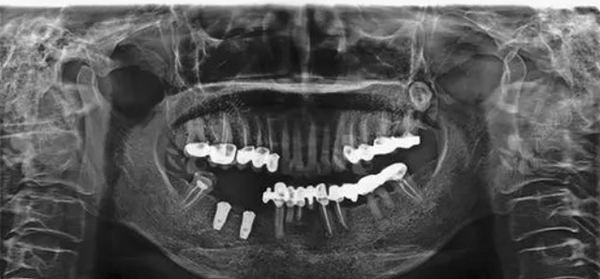 牙齿种植牙片