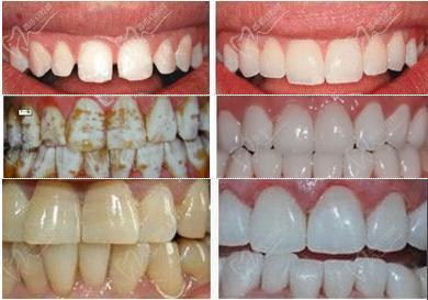 牙贴面解决牙缝大，氟斑牙，四环素牙的效果图