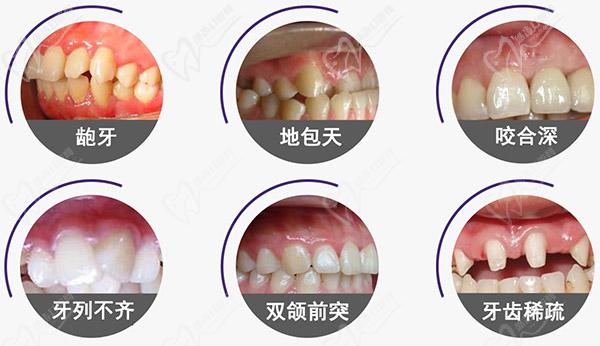 龅牙、地包天、咬合深、牙列不齐、双颌前突、牙齿稀疏这些牙齿情况就需要做牙齿矫正
