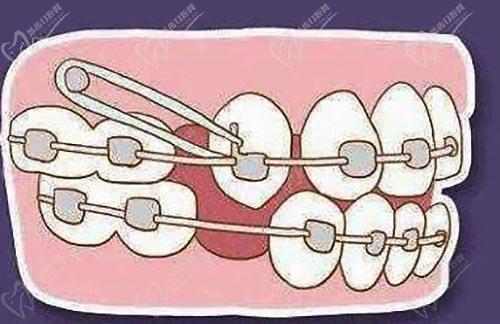 牙齿矫正示范图
