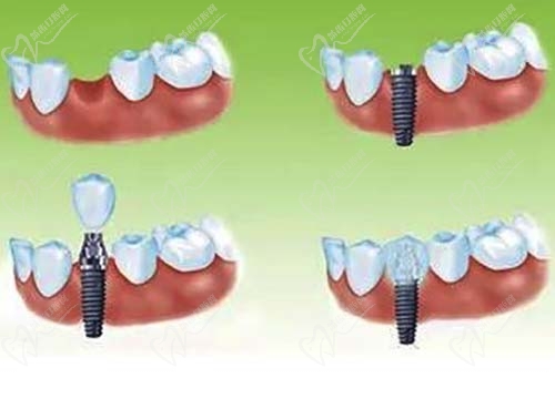 牙齿种植过程步骤图