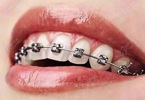 牙齿金属托槽矫正