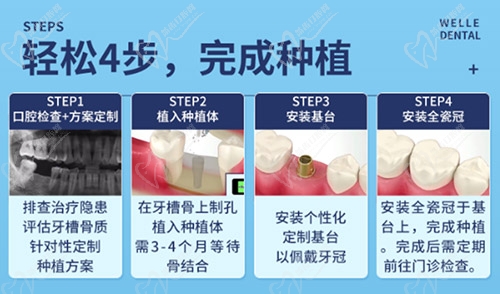 上海维乐口腔种植流程