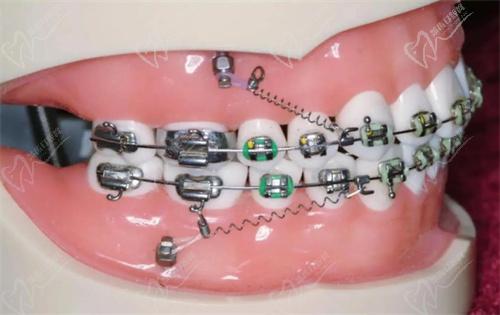 牙博士牙齿矫正示意图
