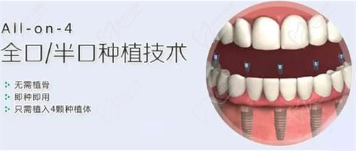 上海全口种植牙医生哪个好？