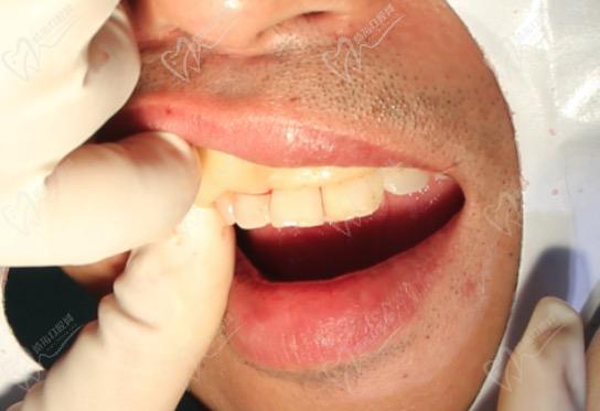 牙周翻瓣术后牙周纤维固定，调合后牙周塞治