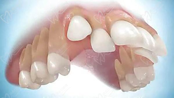 每个人牙齿错颌畸形情况不同