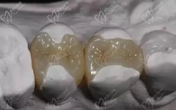 牙齿嵌体4200贵吗是不是被坑了？看嵌体修复和补牙的区别就明了