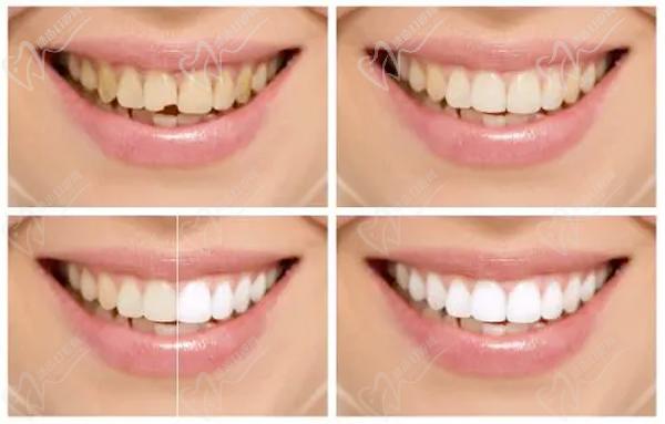 四环素牙的治疗过程