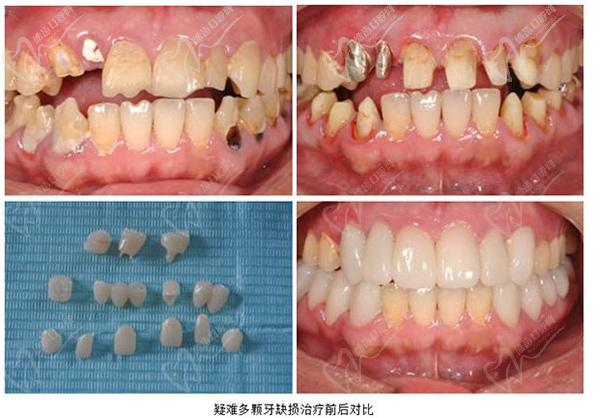 中 国医科大学附属口腔医院种植牙镶牙