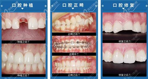 牙齿种植、矫正、修复对比图