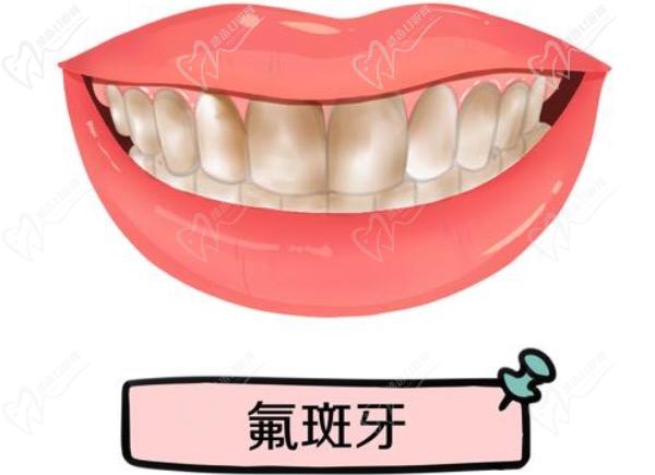 氟斑牙是什么原因造成的？