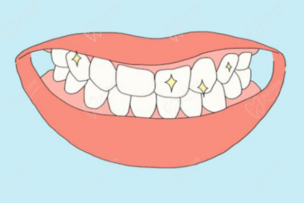 四环素牙属于外源性着色牙吗