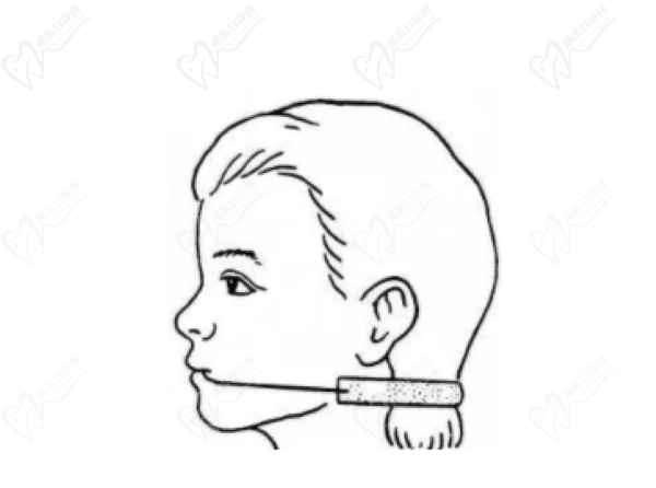 口外弓肌激动器矫治器