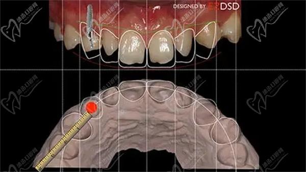 DSD牙齿美学修复技术