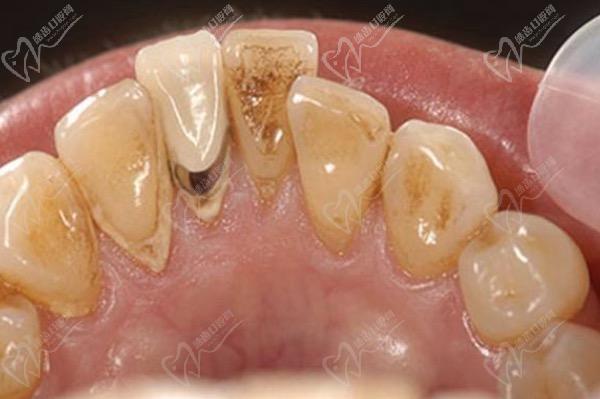 牙釉质损伤有哪些症状？