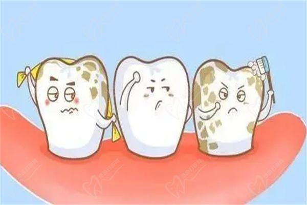 牙齿钙化图片
