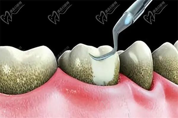 如何治疗牙齿钙化