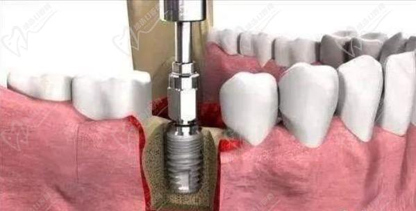 牙齿的种植钉被肉覆盖了怎么办？