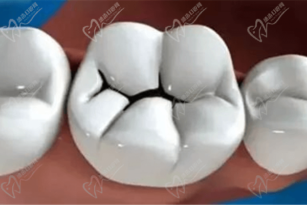 牙齿缝隙里的黑污垢怎么去除