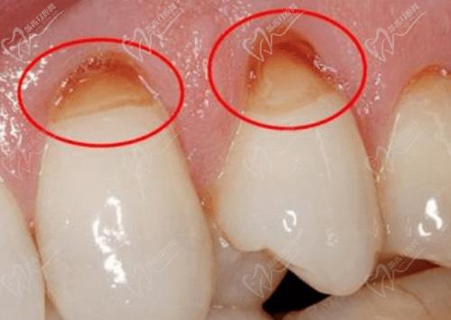 小孩乳牙牙根损坏图片