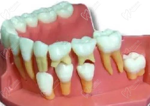 小孩乳牙牙根坏了影响换牙齿吗