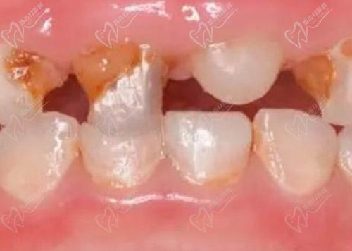 乳牙有必要做根管治疗吗