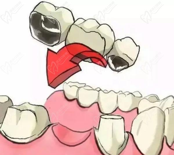 缺失一颗牙做3连桥，为了一颗牙搭桥值得吗?牙搭桥能维持多长时间