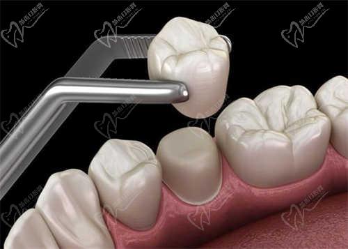 牙齿修复的方法和护理牙齿的方法