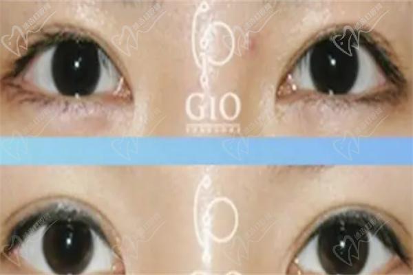 韩国gio整形外科双眼皮修办理不错
